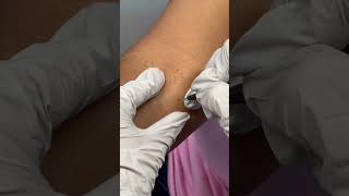 Treating a fibroma using the ThermoClear machine