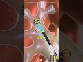 Kidney Stones Removal Surgery 3D Animation (Ureterolithotripsy)#kidneystone #kidneystones