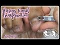 👣Pedicure Tutorial Missing Toenail Reconstruction with Acrylic Transformation👣✔️