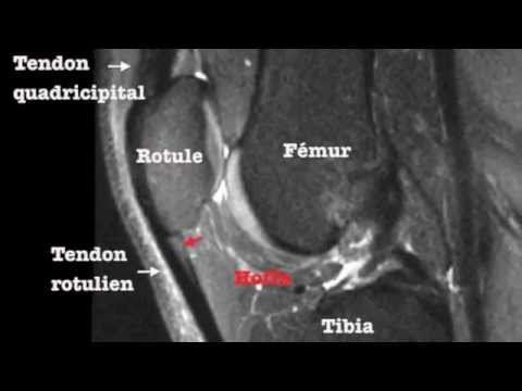 IRM du genou - menisques, ligaments - os - YouTube