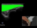 3D-пособие: ультразвуковое исследование латеральной части локтевого сустава — SonoSite