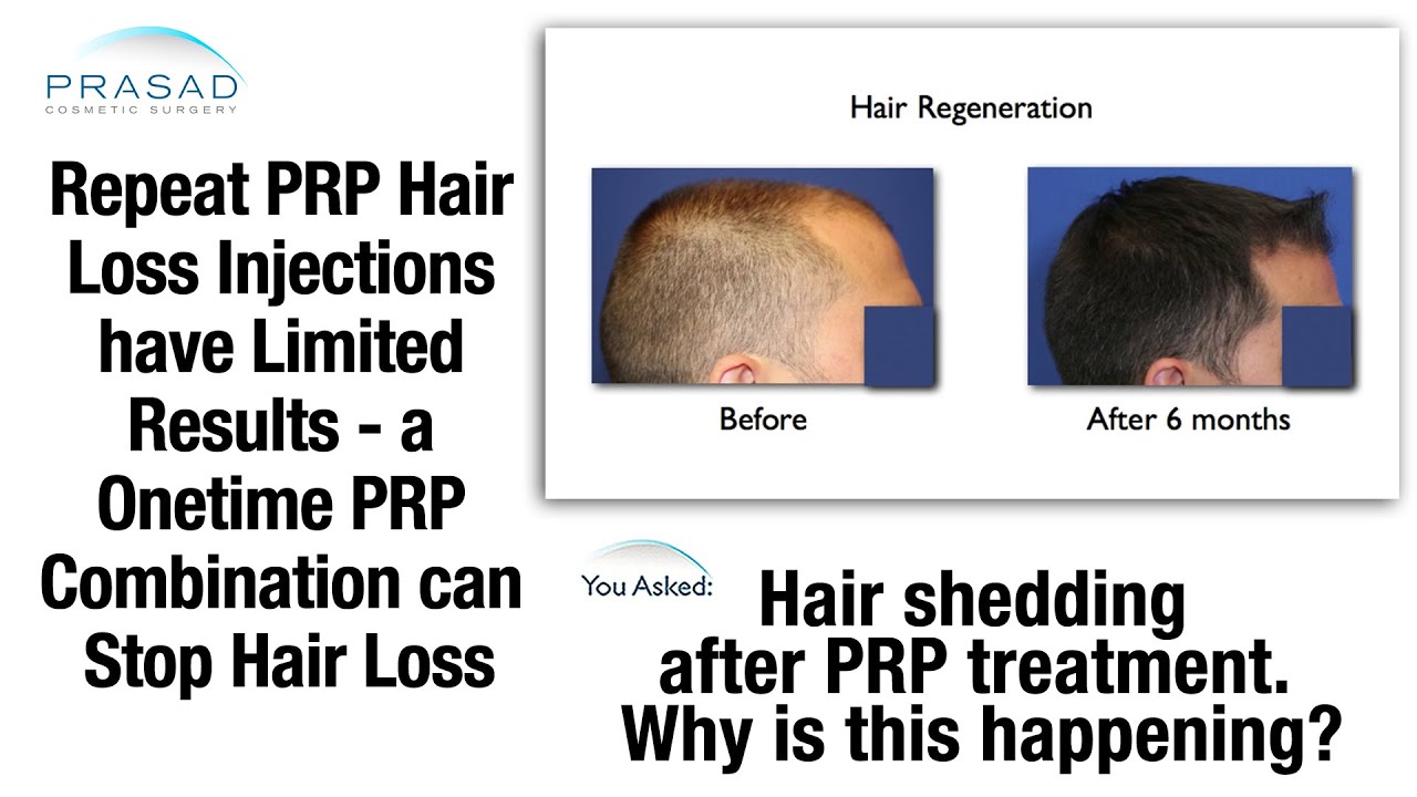 Hair Restoration with Natural Growth Factor Injections  Method Aesthetics