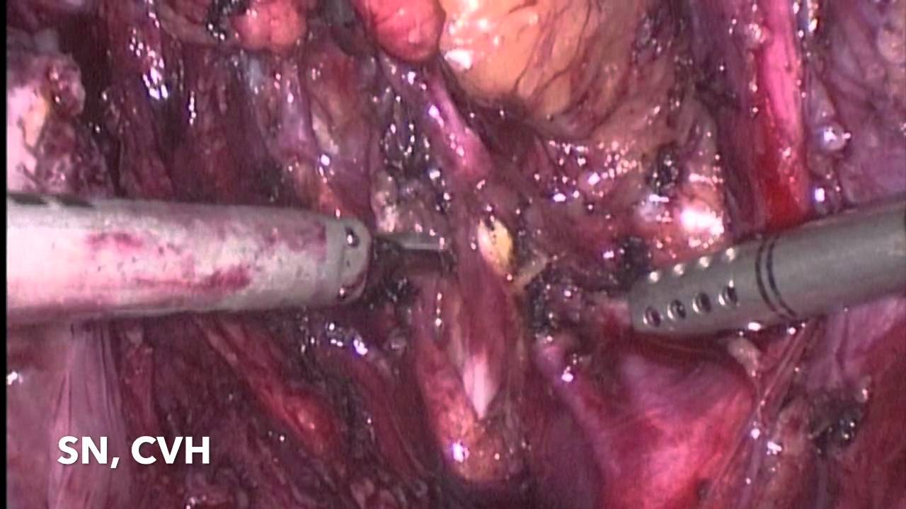 laparoscopic radical hysterectomy cervical cancer YouTube