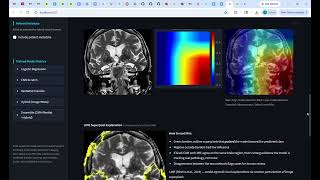 Lumina - Ai Alzheimers Stage Detector Demo