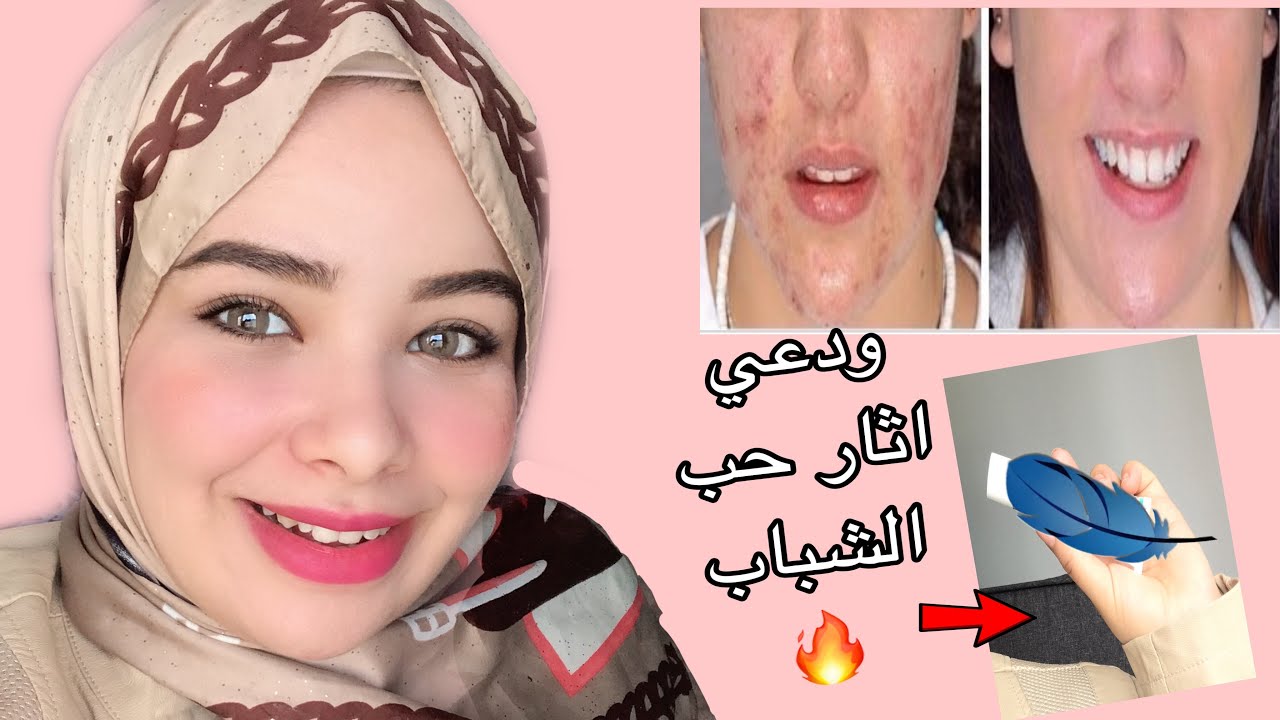كريم بعشره جنيه ينسف اثار الحبوب في ثلاث ايام😱🔥