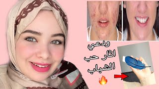 كريم بعشره جنيه ينسف اثار الحبوب في ثلاث ايام😱🔥