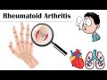 Rheumatoid arthritis  causes pathogenesis signs  symptoms and complications
