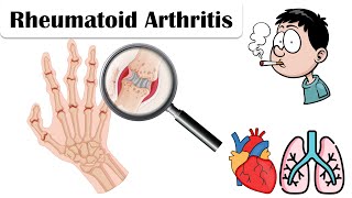 Rheumatoid Arthritis - Causes, Pathogenesis, Signs &amp; Symptoms, And Complications