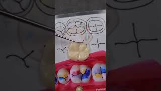 First Molar Inferior