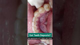 Got Teeth Deposits? Get Ultrasonic Scaling Done Dr. Srishti Bhatia