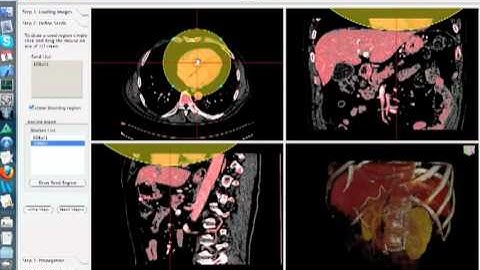 MIALite Introduction III: Liver Segmentation With MIALite