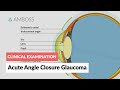 Acute Angle Closure Glaucoma