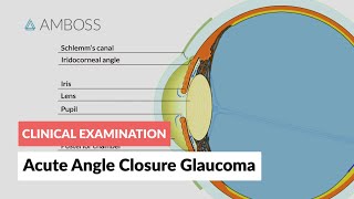 Acute Angle Closure Glaucoma