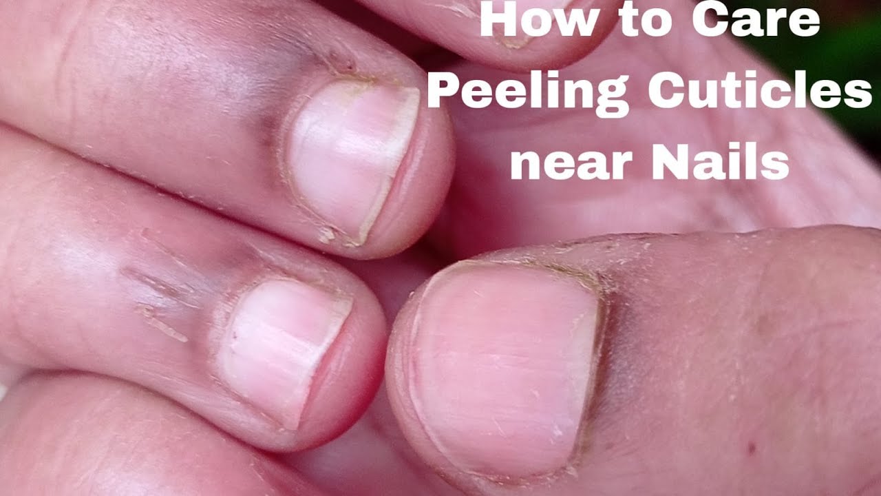 Skin concerns] How to fix my dry peeling cuticles? : r/SkincareAddiction