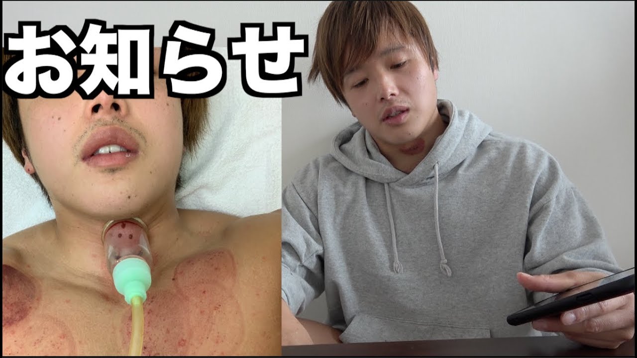 昨日の巨大なキスマークについてお伝え致します Youtube 昨日の巨大なキスマークについてお伝え致します Youtube