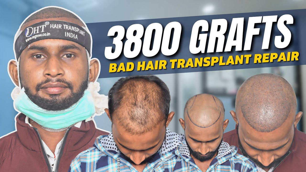 Hair Transplant in Varanasi Best Results & Cost of Hair Transplant in