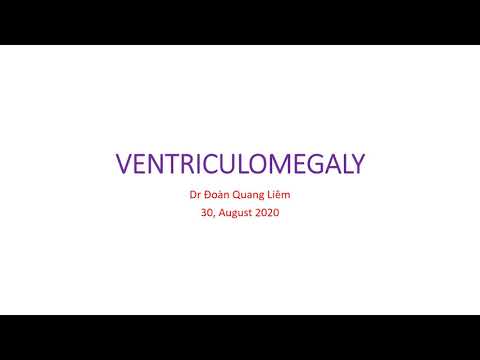 Videó: Ventriculomegalia A Magzatban - Okai, Kezelése, Tünetei