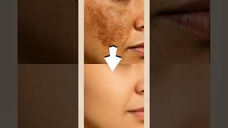 Remove Pigmentation and Dark Spots Using Potato #ashortaday #pigmentationremoval #potatocream