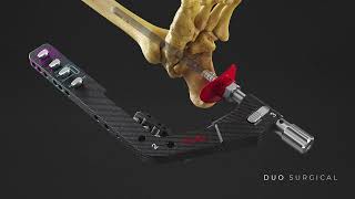 REDEMPTIONᵀᴹ | DUO Hindfoot Nail | Dual Mode Compression | Surgical Technique