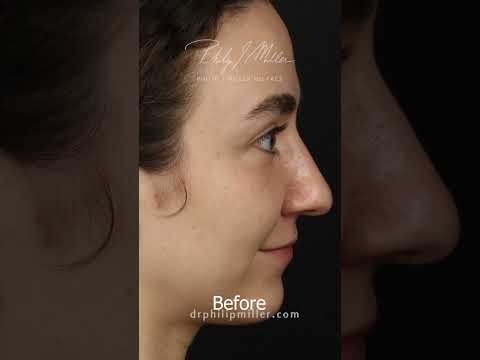 Video thumbnail: 7 Days Post Op Rhinoplasty! Taking The Cast Off My Patient! · Dr. Philip Miller, MD, FACS