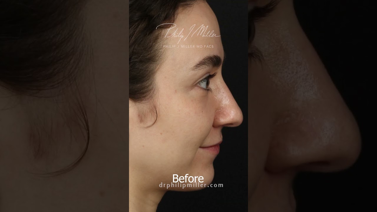 7 Days Post Op Rhinoplasty! Taking The Cast Off My Patient!