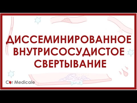 Диссеминированное внутрисосудистое свертывание - что такое, механизм развития, в чем опасность