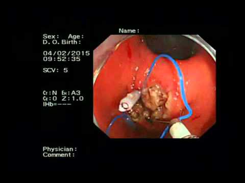 LeClamp - Ligation Device Defect Wall Closure