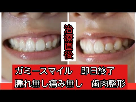 笑うと歯茎が見えすぎるのと左右の歯茎の高さが違うのが気になるキャリアウーマンの女性