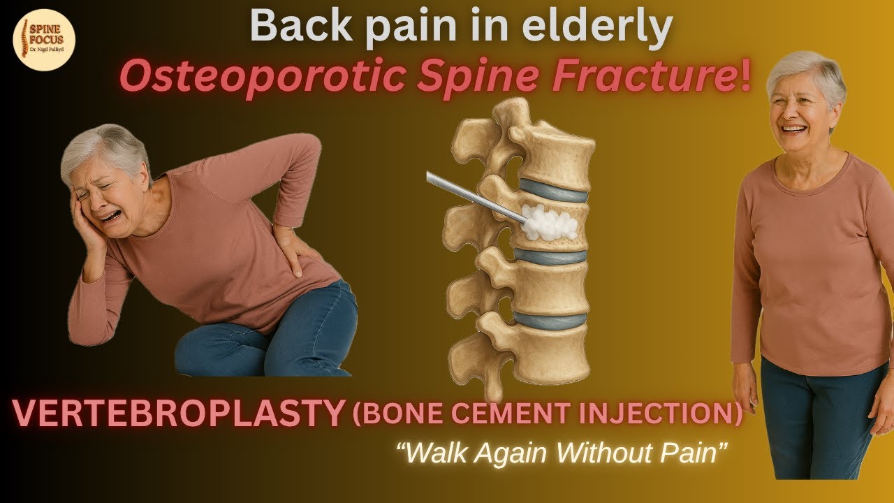VERTEBROPLASTY – Simple and Effective Treatment for Osteoporotic Spine Fractures in the Elderly