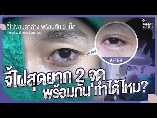 รีวิวตัดไฝ ขี้แมลงวัน EP.177/จี้ไฝขอบตาพร้อมกัน 2 เม็ด @หมอปุ๊ NeramitClinic