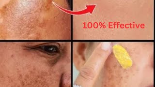 Short time secret of freckles removal| Remove  freckles ,dark spots naturally in summer