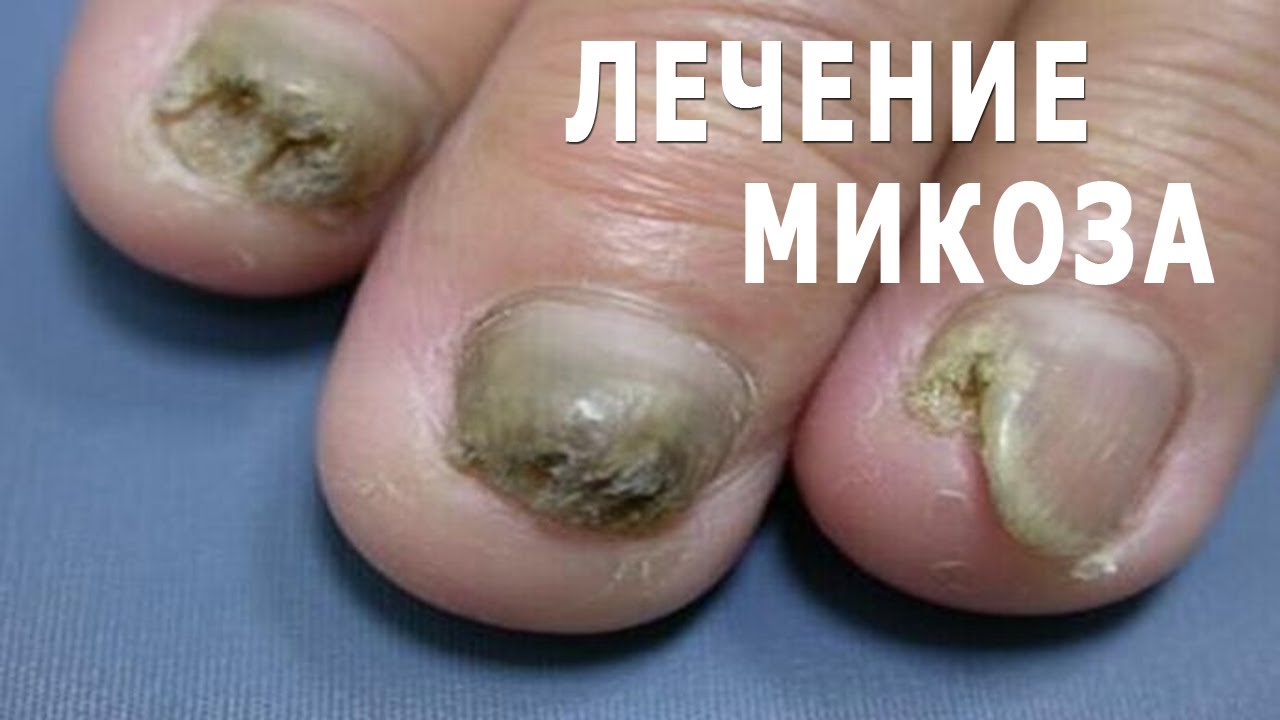 ★Лечение грибка ногтей, (Микоза) на ногах. Лак против грибка ногтей. Средства для снятия ногтя.