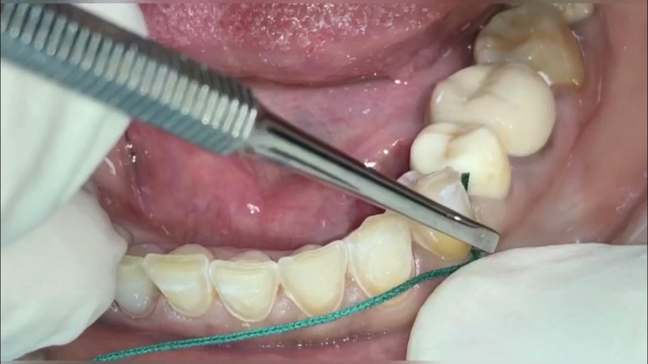 Singlecord technique YouTube