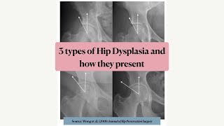 3 types of hip dysplasia and how to identify them
