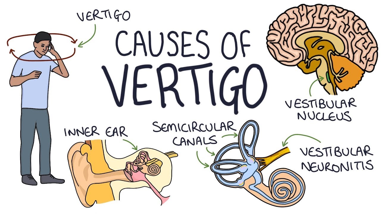 Severe case of vertigo