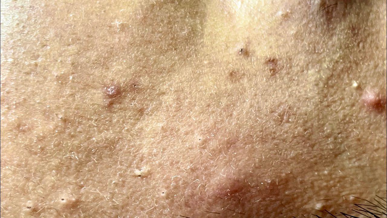 Relaxing acne treatment #233 P3  (Linh My Dang)