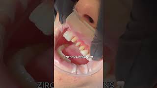 Postavljanje krunica - Hollywood smile 🦷