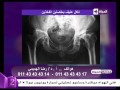 طبيب الحياة -  سبب عملية مفصل الفخد  - د . رضا الهميمي - إستشاري جراحة العظام