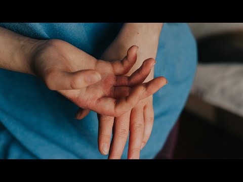Videó: Hogyan Kezeljük A Gyermek Kiütését