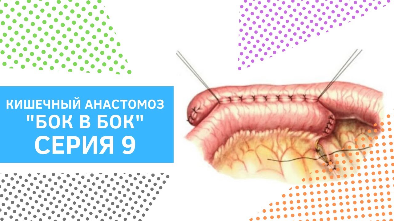 Серия 9. Кишечный анастомоз бок в бок - YouTube