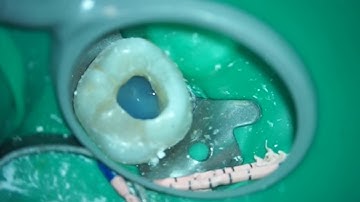 Dr. Jenner performing a root canal with the Seiler Alpha Air Microscope