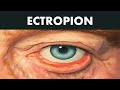 ECTROPION