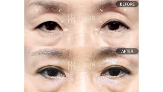 [B&amp;A] 상안검눈매교정+앞트임+윗트임+눈썹거상+안와지방이식 8개월차