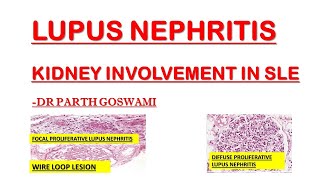 Lupus Nephritis | Wire Loop Lesion