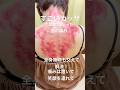 【首の痛み‼️カッサ療法】