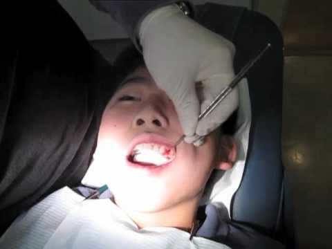 tooth-extraction-:-4-in-60-seconds---tim