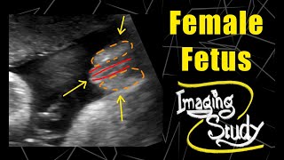 Female Fetus - It's a Girl || Ultrasound || Case 97