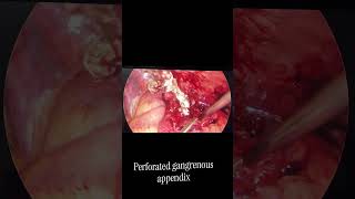 Gangreneous perfotrated appendix( ગેંગરીનિયસ એપેન્ડિક્સ) #hospital #doctor #surgery #surgeon