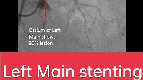 Left main PCI #PTCA #Stenting angiogram #cardiology #Intervention cardiology