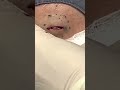 Squeezable Cyst